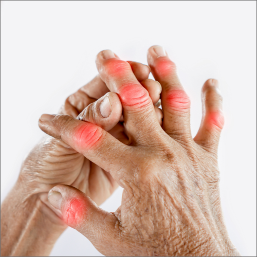arthritis-Los-Alamitos-Physical-Therapy-los-alamitos-ca