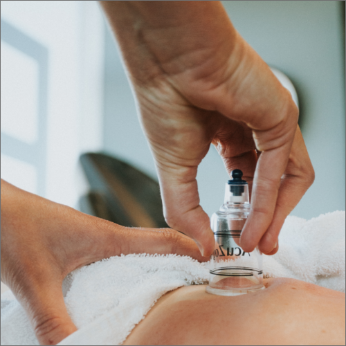 cupping-Los-Alamitos-Physical-Therapy-los-alamitos-ca